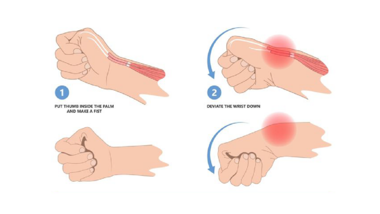Radial side wrist pain – De Quervain Tenosynovitis / Mummy’s thumb ...