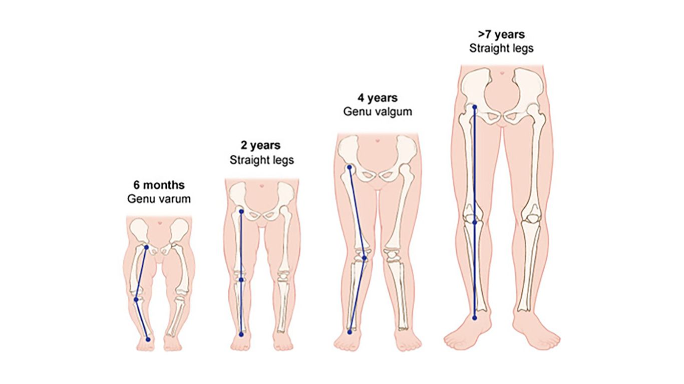 Bow Legs and Knock Knees: What’s Normal and What Needs Treatment? - Dr ...